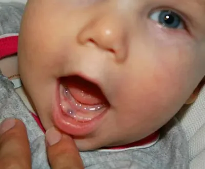 Фото прорезывания зубов у ребенка фотографии
