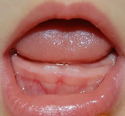 Прорезывание молочных зубов у детей — Gorstom