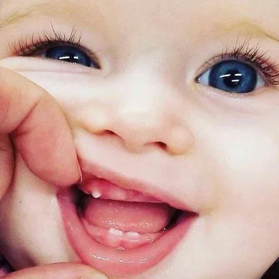 🔎 Киста прорезывания зуба на десне у ребенка - YouTube