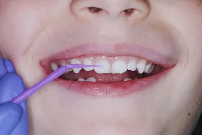 Температура при прорезывании зубов у детей - причины, симптомы, что делать