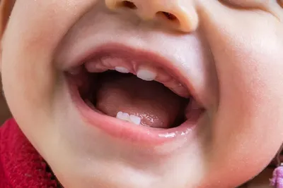 Синяя десна при прорезывании зубов у детей