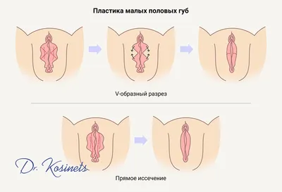 Лабиопластика - Цена операции, сделать пластику половых губ в Минске