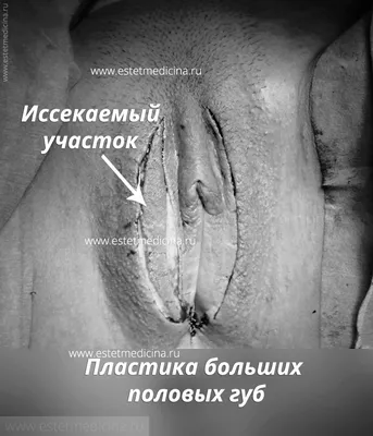 Пластика больших половых губ. Наталия Ваганова | Интернет-журнал  Estetmedicina.ru