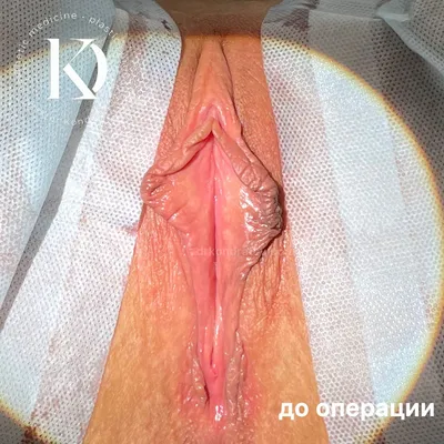 Липофилинг больших половых губ | Пластический хирург Кондратьев Д.Г.