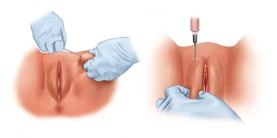 VIVA Clinic - Лабиопластика это раздел пластической хирургии в гинекологии,  которая направлена на коррекцию визуальной формы, объема, строения малых и  больших половых губ, устранение нарушений строения после повреждений во  время родов, травм,
