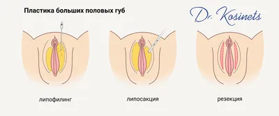 Лабиопластика. Пластика малых и больших половых губ