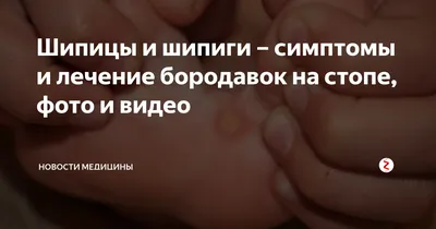 Удаление шипицы лазером в Новосибирске по цене от 500 руб.