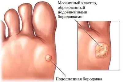 Что такое шипица, и как от нее избавиться?