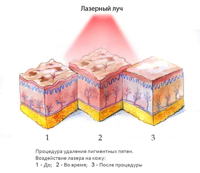 Удаление пигментных пятен в Минске МЦ Кравира