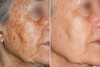 Удаление пигментных пятен на лице. Фото до и после