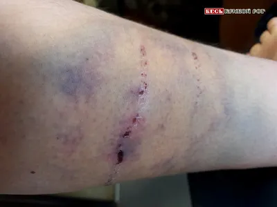 Нога после укуса бродячей собаки распухла у пострадавшей в Кривом Роге —  Новости Кривого Рога