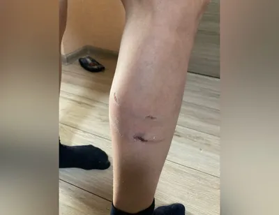Агрессивные собаки разорвали ногу жительнице Кисловодска в Волгограде