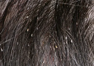 Бельевые вши: чем опасны мелкие вредители и как от них избавиться