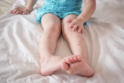 УКУСЫ клопов у детей: фото, как выглядят, симптомы на коже