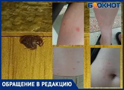 В Новосибирске двум сёстрам запретили ходить в детский сад из-за укусов  загадочных насекомых 20 февраля 2020 года - 21 февраля 2020 - НГС.ру