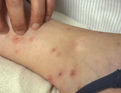 Симптомы укуса комара, блох, пчел - как их распознать | РБК Украина