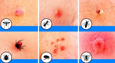 Опасные насекомые и их укусы — блог медицинского центра ОН Клиник