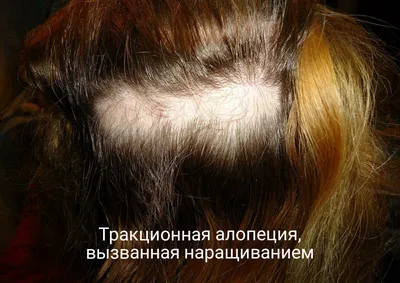 Наращивание Волос� - Многие сомневаются, возможно ли отрастить родную длину  волос с помощью наращивания? Их опасения вызваны тем, что долгая фиксация  донорского материала нарушит естественную красоту собственной шевелюры.  Поверьте, что всё это –