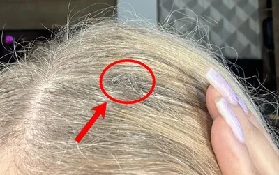 Наращивание волос и алопеция: есть ли связь?