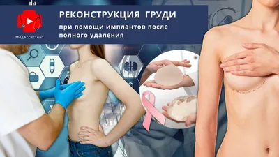 Онкореконструкция молочных желез в Euromed Clinic - Euromed