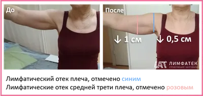 Товары для женщин после мастэктомии