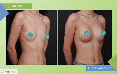 Фото женщин с имплантами после мастэктомии фотографии