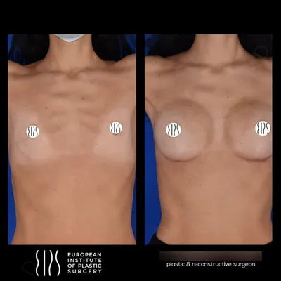 Грудные импланты - Сколько стоит сделать лучшую силиконовую грудь - MedTour