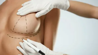 Полное удаление груди или органосберегающая операция? Выбор техники  операции – общее решение оперирующего хирурга и пациентки - Docrates