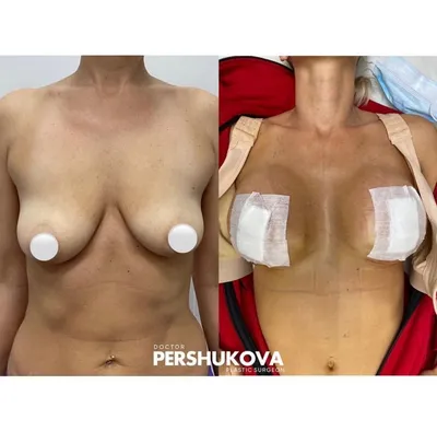 Подтяжка груди с имплантами в Москве - цены, фото