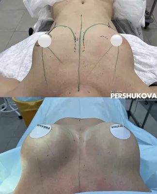 Реконструкция груди после мастэктомии в VIP Clinic в Москве. Операция по  восстановлению груди после удаления, пластика, реконструкция молочных  желез. Цены, отзывы, фото