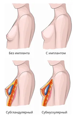 Увеличение груди: преимущества и недостатки операции | Киев