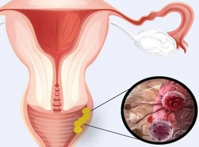 Женские внутренние половые органы - Проблемы со здоровьем у женщин -  Справочник MSD Версия для потребителей