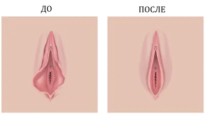 Операция по коррекции малых половых губ
