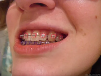 Снятие брекетов с зубов: когда и как снимают брекеты - Underson Clinic