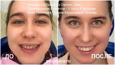 Разъехались зубы после ношения брекетов, капа сломалась, возможно ли  восстановит прикус в этот раз без брекетов? | Пикабу