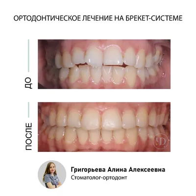 Профессиональная чистка зубного налета после лечения брекетами