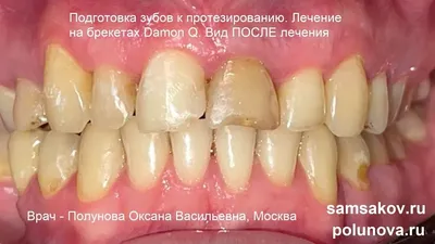 Рекомендации после снятия брекет-системы | Стоматология ПрофиСмайл