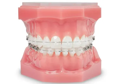 Желтеют ли зубы от брекетов? | Dentell
