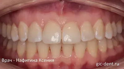 Могут ли вернуться зубы в исходное состояние после снятия брекет-системы? |  Dentell
