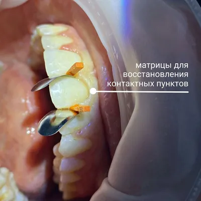 Исправление прикуса у взрослых и детей по хорошей цене - Капы после брекетов.  Исправить прикус в Москве, быстро и недорого