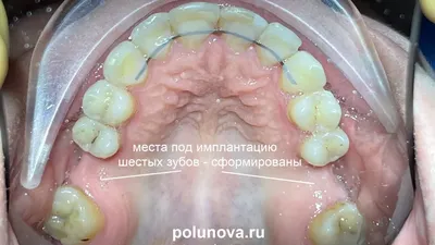 Шинирование зубов после брекетов — зачем устанавливают шину | Dental Art
