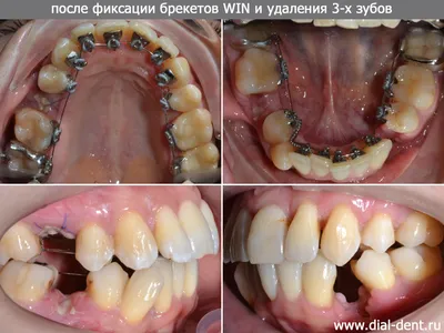 Фото работы до и после — Исправление прикуса с помощью брекет-системы Damon