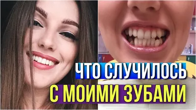 Как привыкнуть к брекетам? - блог стоматологии