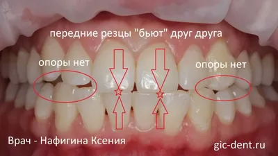 Лечение протрузии резцов и смыкания зубов брекетами непрямой фиксации