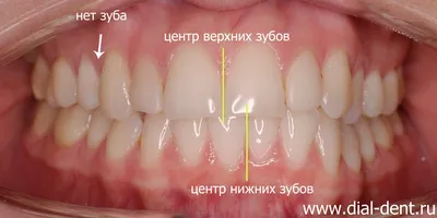 Прорезывание зубов у детей: симптомы и осложнения