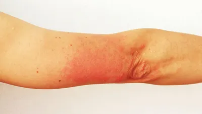 Аллергия на солнце (фотодерматит): лечение, симптомы, причины возникновения