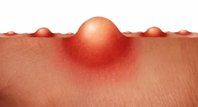Фурункулы на половых губах: возможные причины и терапия