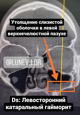 Компьютерная томогорафия придаточных пазух носа - фото - ЛОР в Самаре -  врач Лунёв Андрей Владимирович