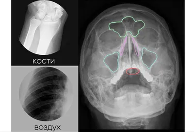 Как заподозрить гайморит | Доктор Черепок | Дзен