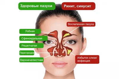 СИНУСИТЫ: Краткий ликбез | Пикабу